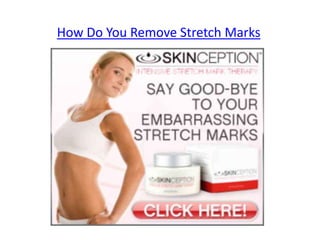 How Do You Remove Stretch Marks
 