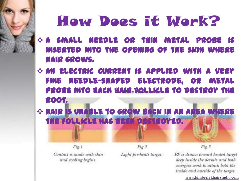How electrolysis hair removal technique works