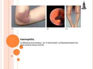 haemophilia.
(a) Bleeding around elbow. (b) A retinal bleed. (c) Repeated bleeds into
joints produce severe arthritis.
 