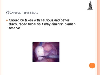 OVARIAN DRILLING
 Should be taken with cautious and better
discouraged because it may diminish ovarian
reserve.
 