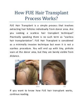 How FUE Hair Transplant
Process Works?
FUE Hair Transplant is a simple process that involves
extracting hair follicles individually from donor area. Are
you seeking a scarless hair transplant technique?
Practically speaking there is no such term as “scarless
hair transplantation”. FUE Hair Transplant is considered
as a minimally invasive technique but even it is not a
scarless procedure. You will end up with tiny, pinhole
scars at the donor area, but they are barely visible from
distance.
If you want to know how FUE hair transplant works,
continue reading.
 