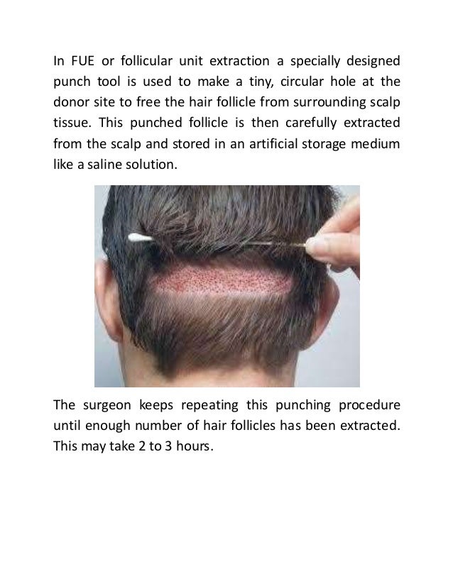 how fue hair transplant process works hair transplant how it works
