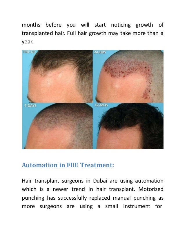 how fue hair transplant process works hair transplant how it works