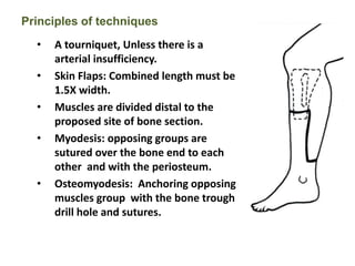 • A tourniquet, Unless there is a
arterial insufficiency.
• Skin Flaps: Combined length must be
1.5X width.
• Muscles are divided distal to the
proposed site of bone section.
• Myodesis: opposing groups are
sutured over the bone end to each
other and with the periosteum.
• Osteomyodesis: Anchoring opposing
muscles group with the bone trough
drill hole and sutures.
Principles of techniques
 