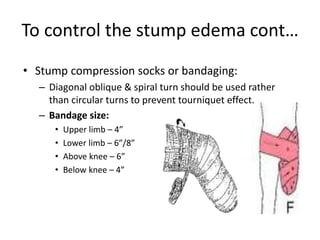 To control the stump edema cont…
• Stump compression socks or bandaging:
– Diagonal oblique & spiral turn should be used rather
than circular turns to prevent tourniquet effect.
– Bandage size:
• Upper limb – 4”
• Lower limb – 6”/8”
• Above knee – 6”
• Below knee – 4”
 
