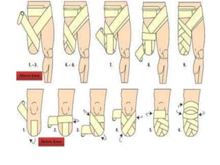 Above knee
Below knee
 