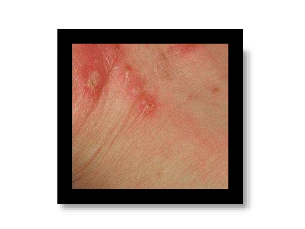 How is scabies treated in humans, what is scabies, how to get rid of