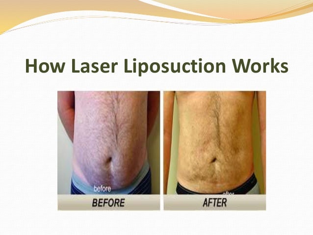 does liquid lipo really work