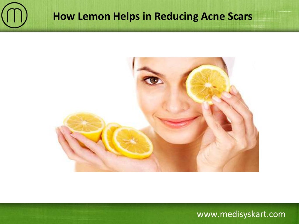How Lemon Helps in Reducing Acne Scars