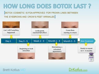 How long does Botox last?