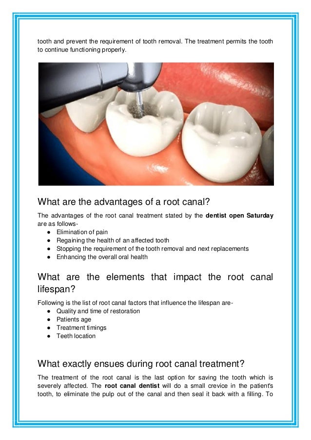 How Long Does A Root Canal Last.pdf