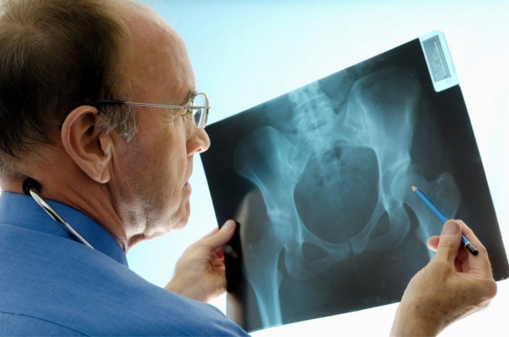 How Long Does Hip Replacement Surgery Last and What Can You Expect?