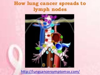 How lung cancer spreads to
lymph nodes
http://lungcancersymptomsx.com/
 