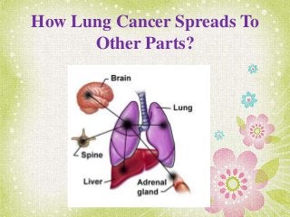 How Lung Cancer Spreads To
Other Parts?
 