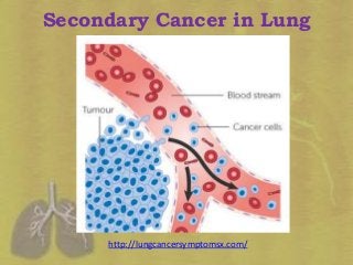 Secondary Cancer in Lung
http://lungcancersymptomsx.com/
 