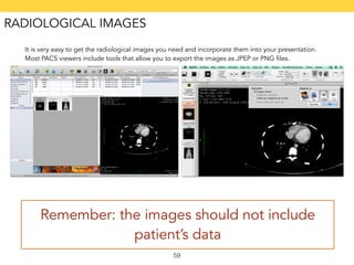 It is very easy to get the radiological images you need and incorporate them into your presentation. 
Most PACS viewers include tools that allow you to export the images as JPEP or PNG files. 
Remember: the images should not include 
patient’s data 
59 
RADIOLOGICAL IMAGES 
 