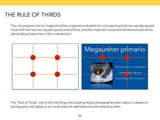 The rule proposes that an image should be imagined as divided into nine equal parts by two equally spaced 
horizontal lines and two equally spaced vertical lines, and that important compositional elements should be 
placed along these lines or their intersections. 
Megauréter primario 
Poco frecuente, no hereditario 
Varones; lado izquierdo 
Asintomático, ITU, hematuria… 
The “Rule of Thirds” one of the first things that budding digital photographers learn about in classes on 
photography and rightly so as it is the basis for well balanced and interesting shots. 
60 
THE RULE OF THIRDS 
 