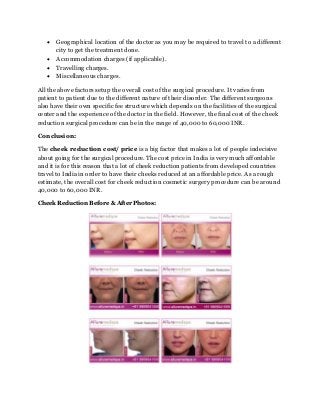  Geographical location of the doctor as you may be required to travel to a different
city to get the treatment done.
 Accommodation charges (if applicable).
 Travelling charges.
 Miscellaneous charges.
All the above factors setup the overall cost of the surgical procedure. It varies from
patient to patient due to the different nature of their disorder. The different surgeons
also have their own specific fee structure which depends on the facilities of the surgical
center and the experience of the doctor in the field. However, the final cost of the cheek
reduction surgical procedure can be in the range of 40,000 to 60,000 INR.
Conclusion:
The cheek reduction cost/ price is a big factor that makes a lot of people indecisive
about going for the surgical procedure. The cost price in India is very much affordable
and it is for this reason that a lot of cheek reduction patients from developed countries
travel to India in order to have their cheeks reduced at an affordable price. As a rough
estimate, the overall cost for cheek reduction cosmetic surgery procedure can be around
40,000 to 60,000 INR.
Cheek Reduction Before & After Photos:
 