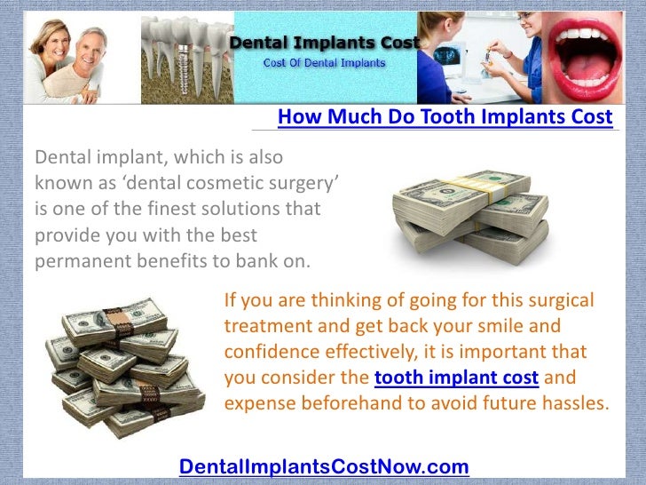 How Much Do Tooth Implants Cost