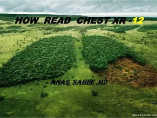 HOW READ CHEST XR -12




     ANAS SAHLE ,MD
 