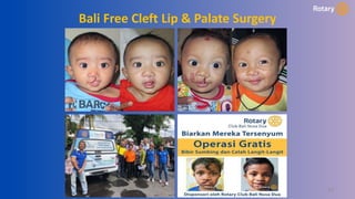 27
Bali Free Cleft Lip & Palate Surgery
 
