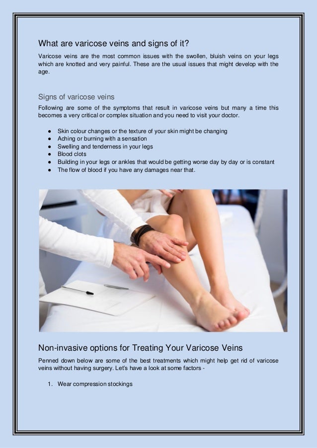 How should i eliminate my varicose veins without surgery