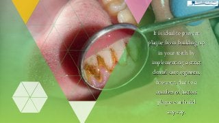 It is ideal to prevent
plaque from building up
in your teeth by
implementing a strict
dental care regimen,
however, due to a
number of factors
plaque can build
anyway.
 