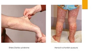 Ehlers-Danlos syndrome Henoch-schonlein purpura 
 
