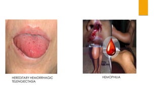 HEREDITARY HEMORRHAGIC 
TELENGIECTASIA 
HEMOPHILIA 
 