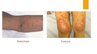 Petechiae Purpura 
 