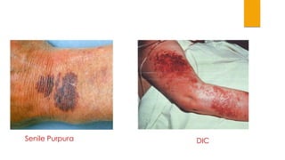 Senile Purpura DIC 
 