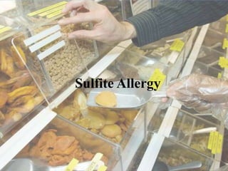 Sulfite Allergy
 