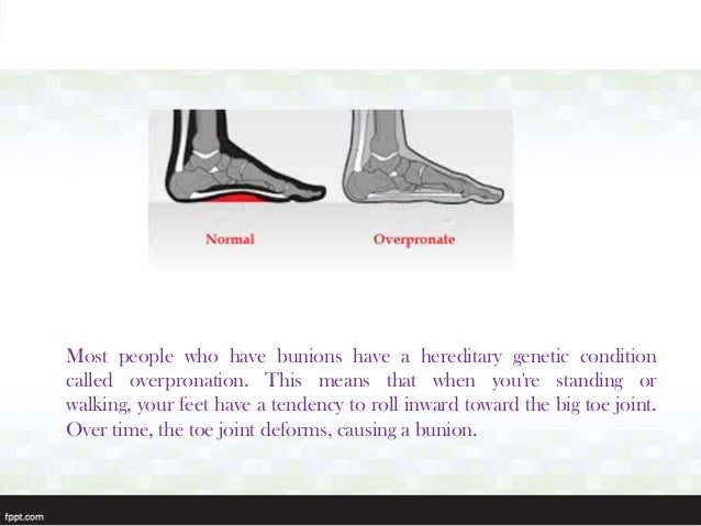 How to avoid getting bunions