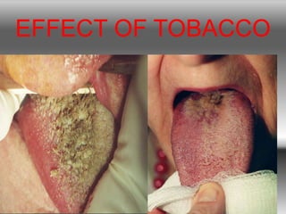 EFFECT OF TOBACCO
 