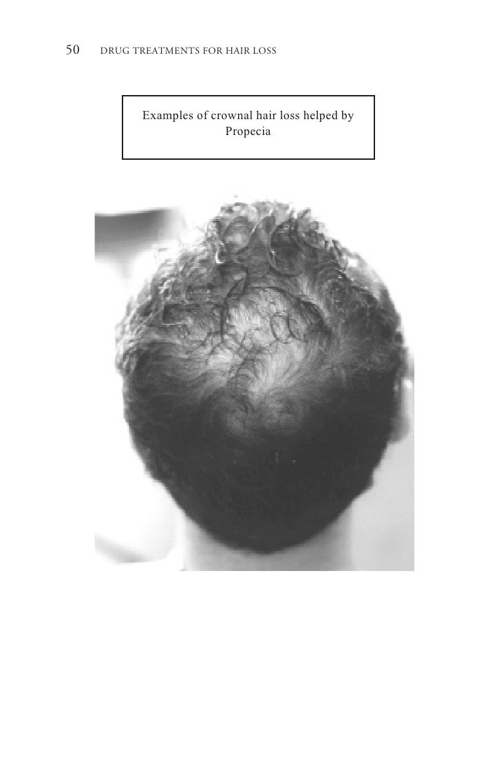 weight gain from finasteride pill