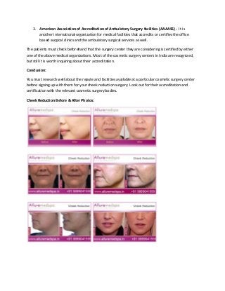 3. American Association of Accreditation of Ambulatory Surgery facilities (AAAASS) - It is
another international organization for medical facilities that accredits or certifies the office
based surgical clinics and the ambulatory surgical services as well.
The patients must check beforehand that the surgery center they are considering is certified by either
one of the above medical organizations. Most of the cosmetic surgery centers in India are recognized,
but still it is worth inquiring about their accreditation.
Conclusion:
You must research well about the repute and facilities available at a particular cosmetic surgery center
before signing up with them for your cheek reduction surgery. Look out for their accreditation and
certification with the relevant cosmetic surgery bodies.
Cheek Reduction Before & After Photos:
 
