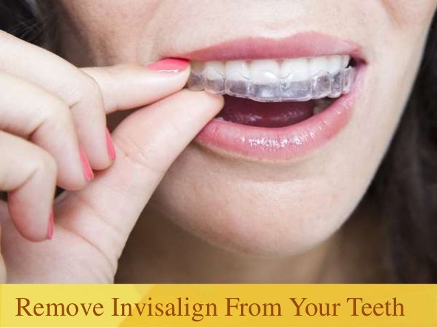 How To Clean Invisalign Aligners