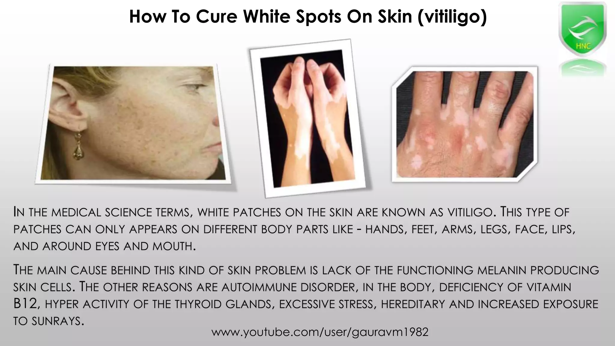 How To Cure White Spot On Skin VITILIGO Treatment Naturally PPT