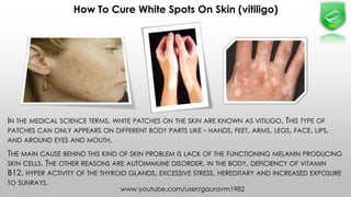 How To Cure White Spots On Skin (vitiligo)
www.youtube.com/user/gauravm1982
 