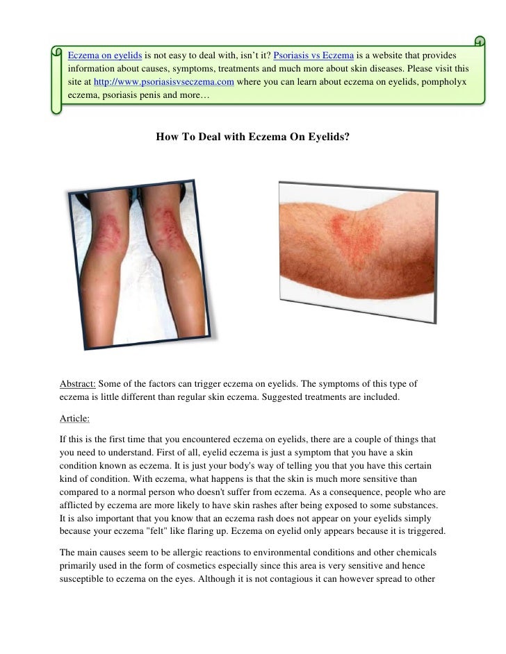 How To Deal With Eczema On Eyelids
