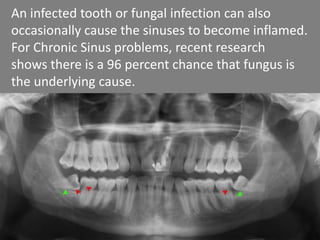 An infected tooth or fungal infection can also
occasionally cause the sinuses to become inflamed.
For Chronic Sinus problems, recent research
shows there is a 96 percent chance that fungus is
the underlying cause.
 