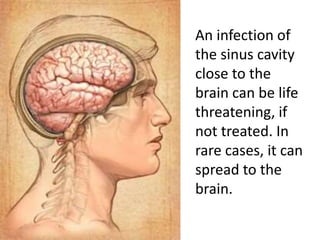 An infection of
the sinus cavity
close to the
brain can be life
threatening, if
not treated. In
rare cases, it can
spread to the
brain.
 