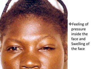 Feeling of
pressure
inside the
face and
Swelling of
the face
 