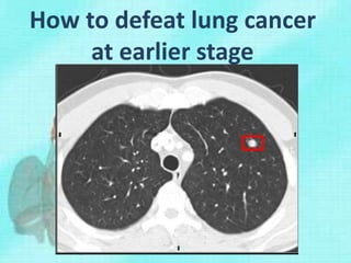 How to defeat lung cancer
at earlier stage
 