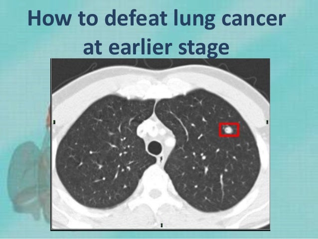 How to defeat lung cancer
at earlier stage
 