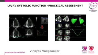 Vinayak Vadgaonkar
LV/RV SYSTOLIC FUNCTION -PRACTICAL ASSESSMENT
 