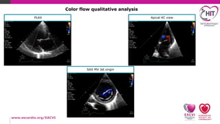 How to echo-Mitral regurgitation-Practical tips | PPTX
