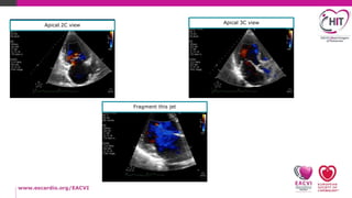 How to echo-Mitral regurgitation-Practical tips | PPTX