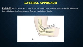 How to manage elbow stiffness | PPTX