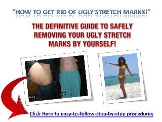 How to eliminate stretch marks